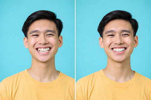 crowded teeth smile fix