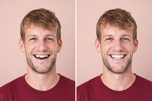 misaligned teeth smile fix