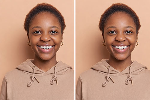 teeth gap smile fix