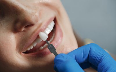 Composite vs Porcelain Veneers: A Clear Guide to the Best Option for Your Smile