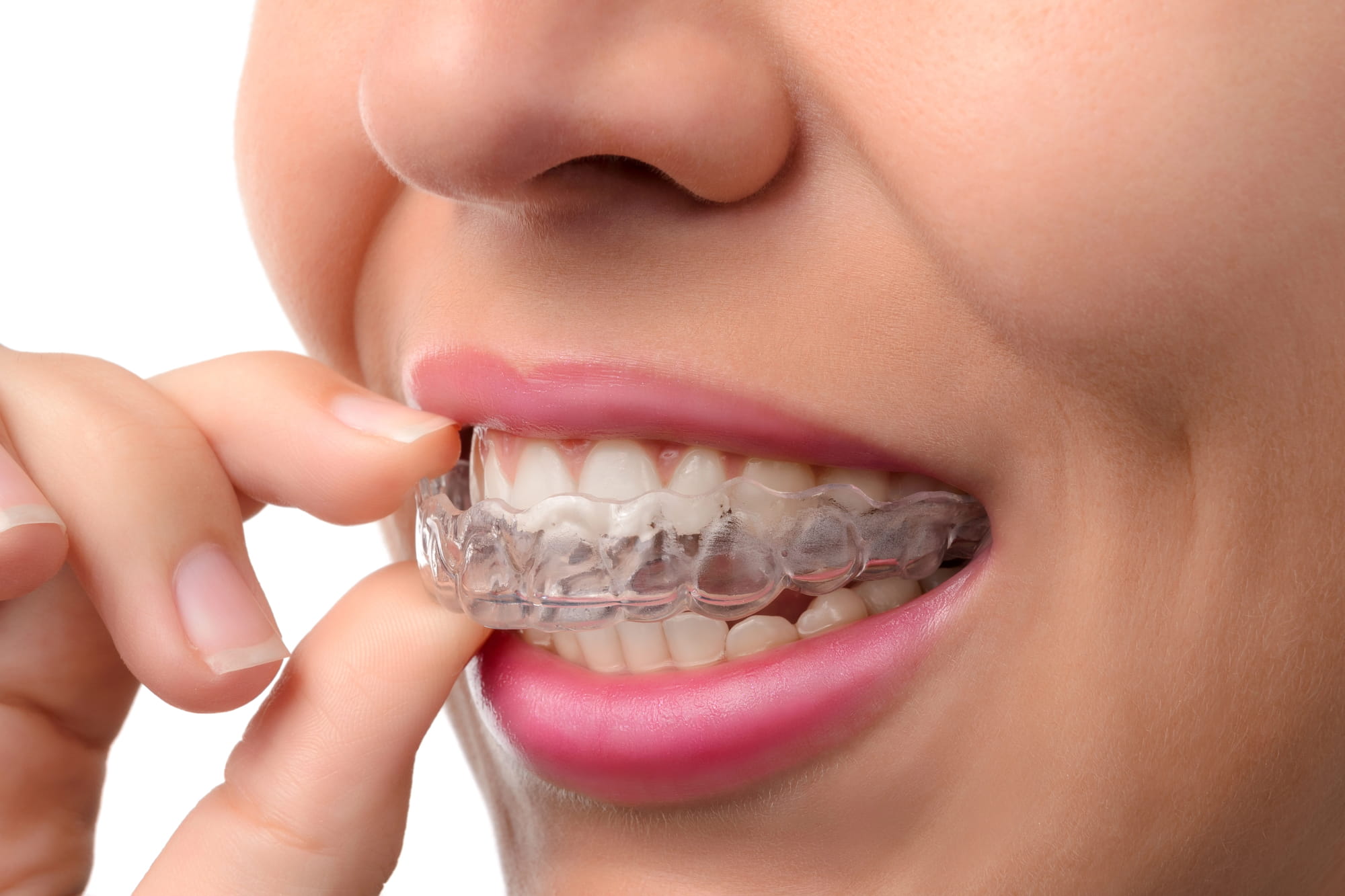 Invisalign Refinements