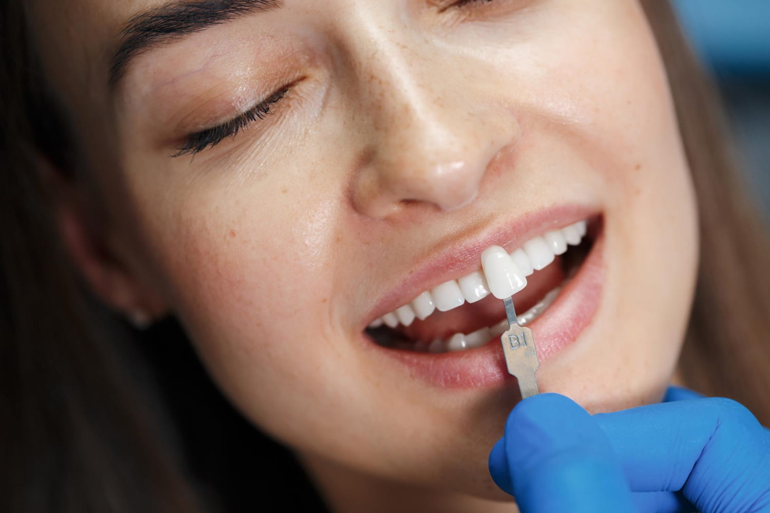 what are veneers and how do they work