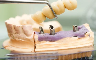 Implants vs Bridges: Which Tooth Replacement Actually Lasts Longer